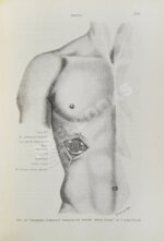 Кохер, Т. Учение о хирургических операциях д-ра Т. Кохера