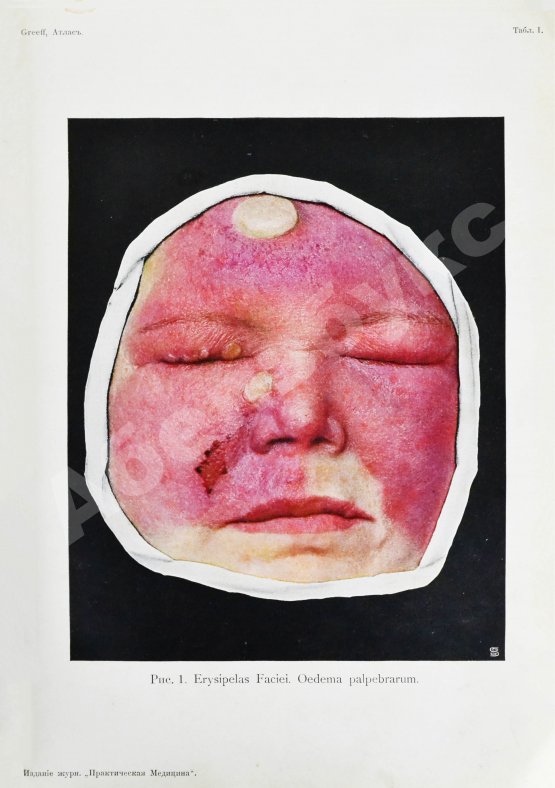 Грифф, К.Р. Атлас наружных заболеваний глаза для врачей и студентов