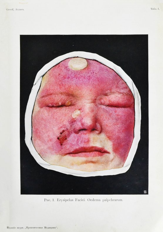 Грифф, К.Р. Атлас наружных заболеваний глаза для врачей и студентов