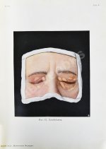 Грифф, К.Р. Атлас наружных заболеваний глаза для врачей и студентов