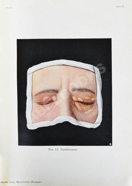 Грифф, К.Р. Атлас наружных заболеваний глаза для врачей и студентов