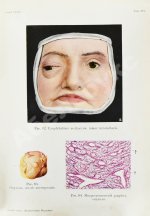 Грифф, К.Р. Атлас наружных заболеваний глаза для врачей и студентов