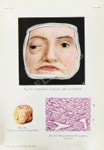 Грифф, К.Р. Атлас наружных заболеваний глаза для врачей и студентов