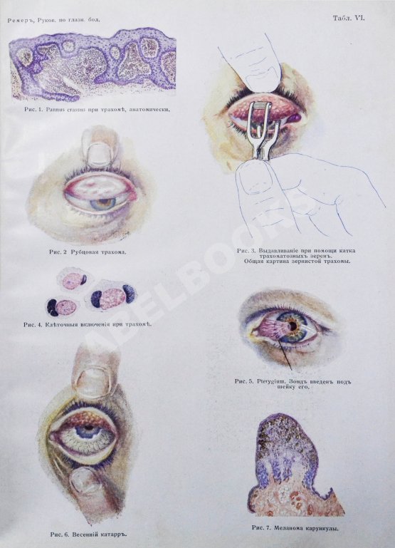 Антикварная книга Рёмер, П. Руководство по глазным болезням