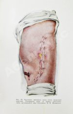 Арьев, Т.Я., Никитин, Г.Д. [автограф] Мышечная пластика костных полостей