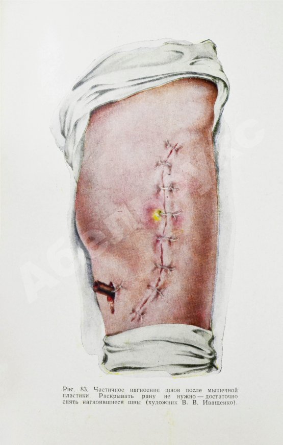 Антикварная книга Арьев, Т.Я., Никитин, Г.Д. [автограф] Мышечная пластика костных полостей